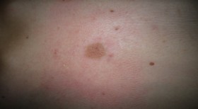 Skin lesion