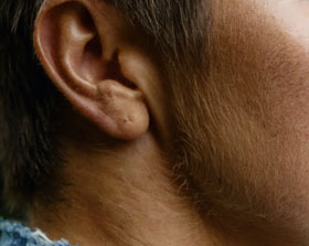 Silhouette Thread Lifts / Softlift
